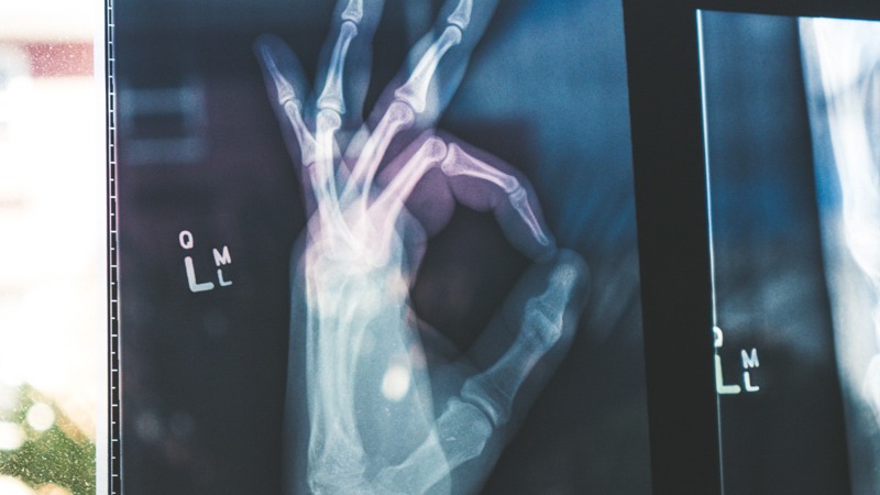 xray image of a person's hand doing ok gesture