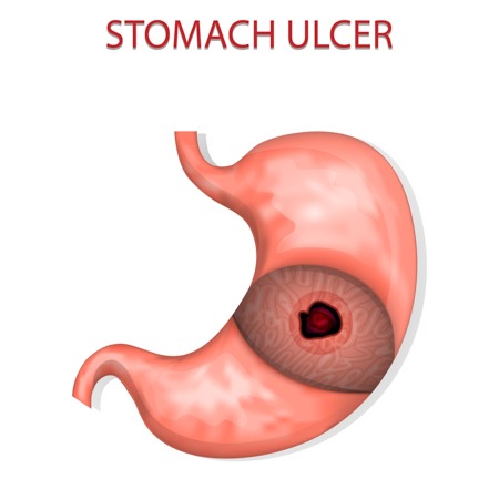 illustration of the stomach ulcers