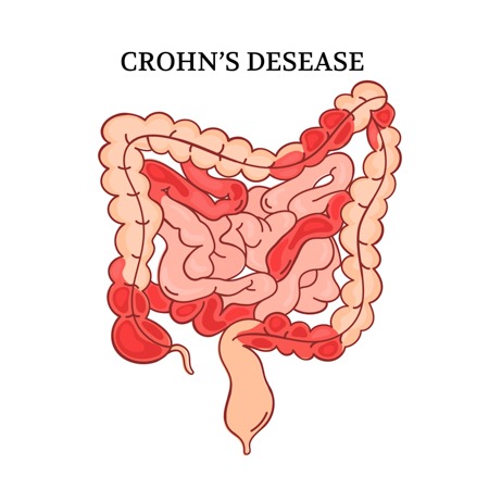 crohn's disease illustration on white background