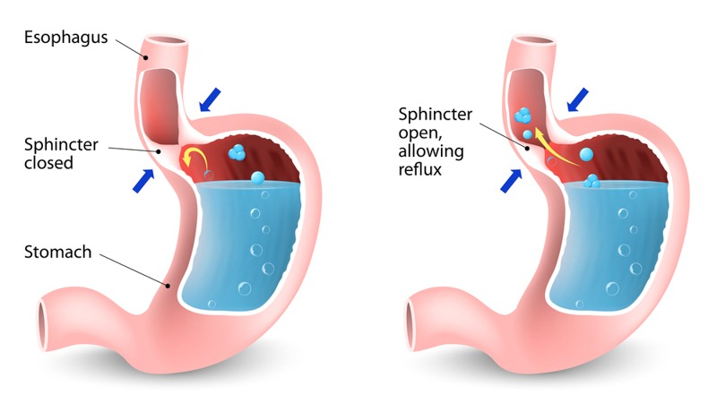 acid reflux gerd disease and healthy stomach illustration on white background