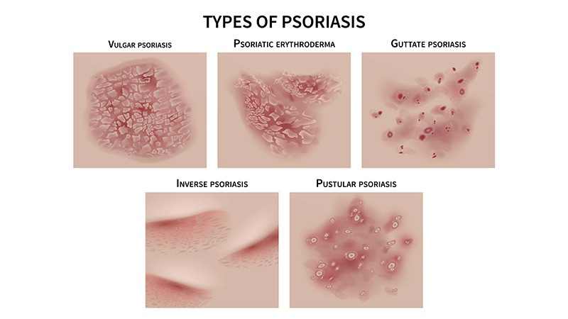 type of psoriasis