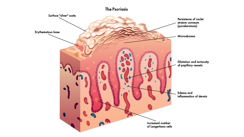 proriasis illustration