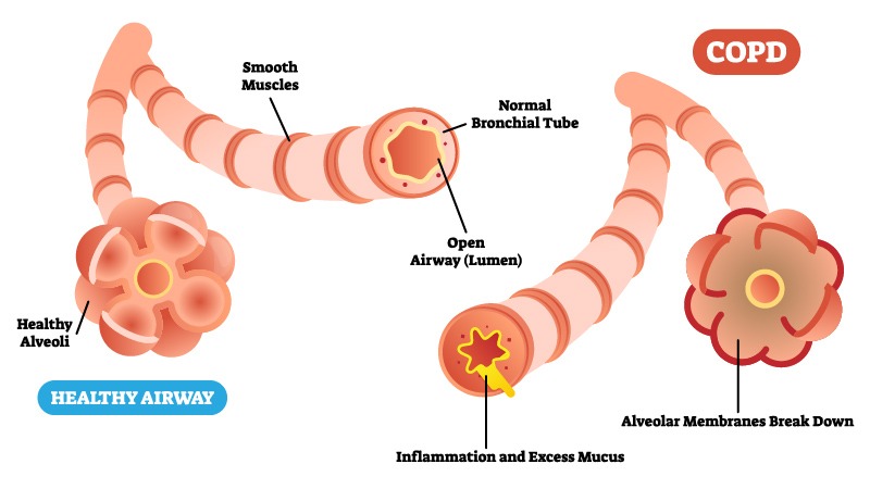 Illustration of COPD on white background