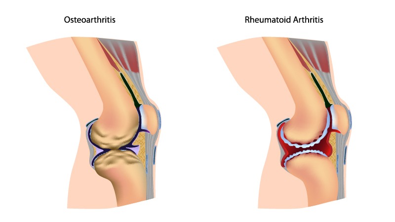 illustration of a common arthritis