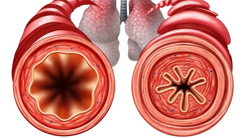 Illustration of Asthma in the Bronchial Tube