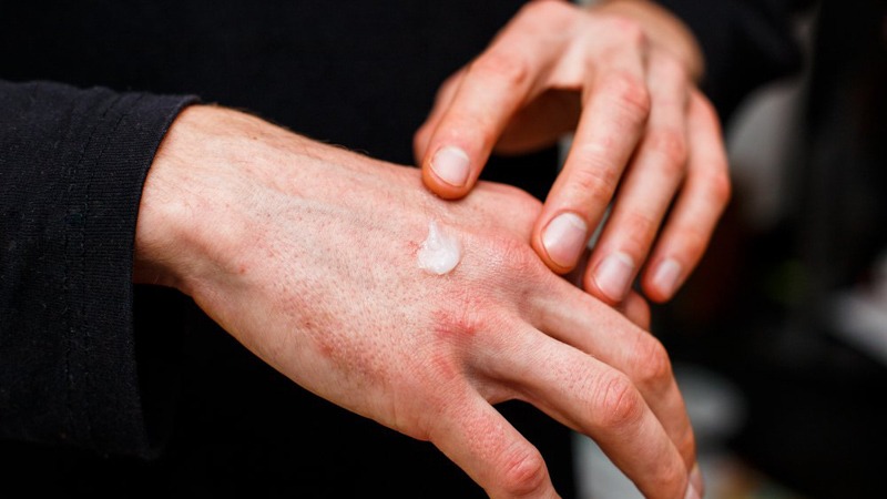 Person Wearing Black Applying Cream to the Hand